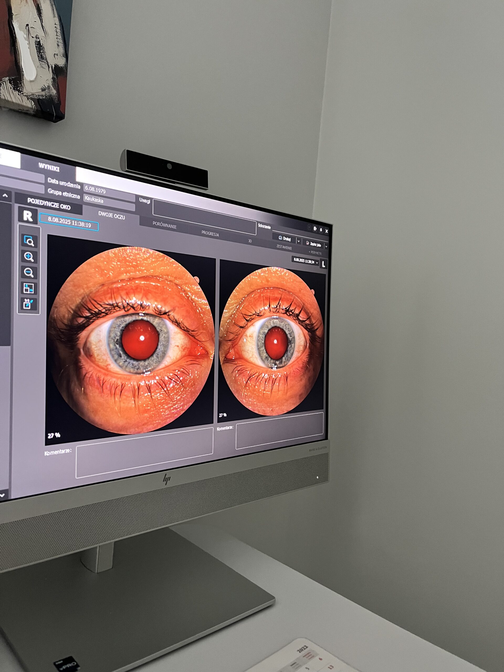 zdjęcie przedniego odcinka w aparacie OCT