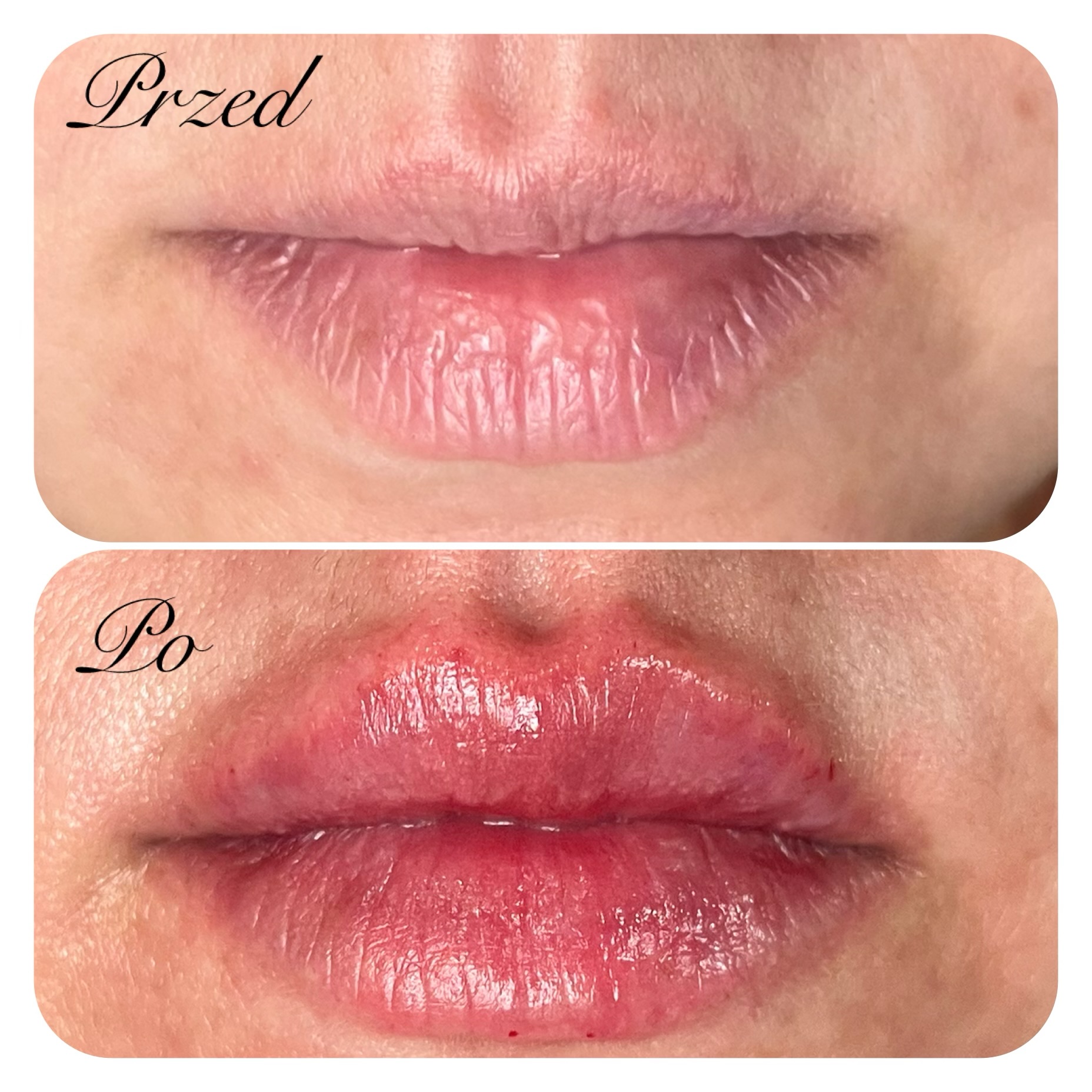 zabieg wykonała dr Agnieszka Nasiłowska-Paciorek. Powiększanie ust kwasem hialuronowym.