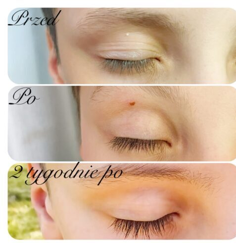 zabieg wykonała dr Agnieszka Nasiłowska-Paciorek. Usunięcie prosaka powieki górnej.