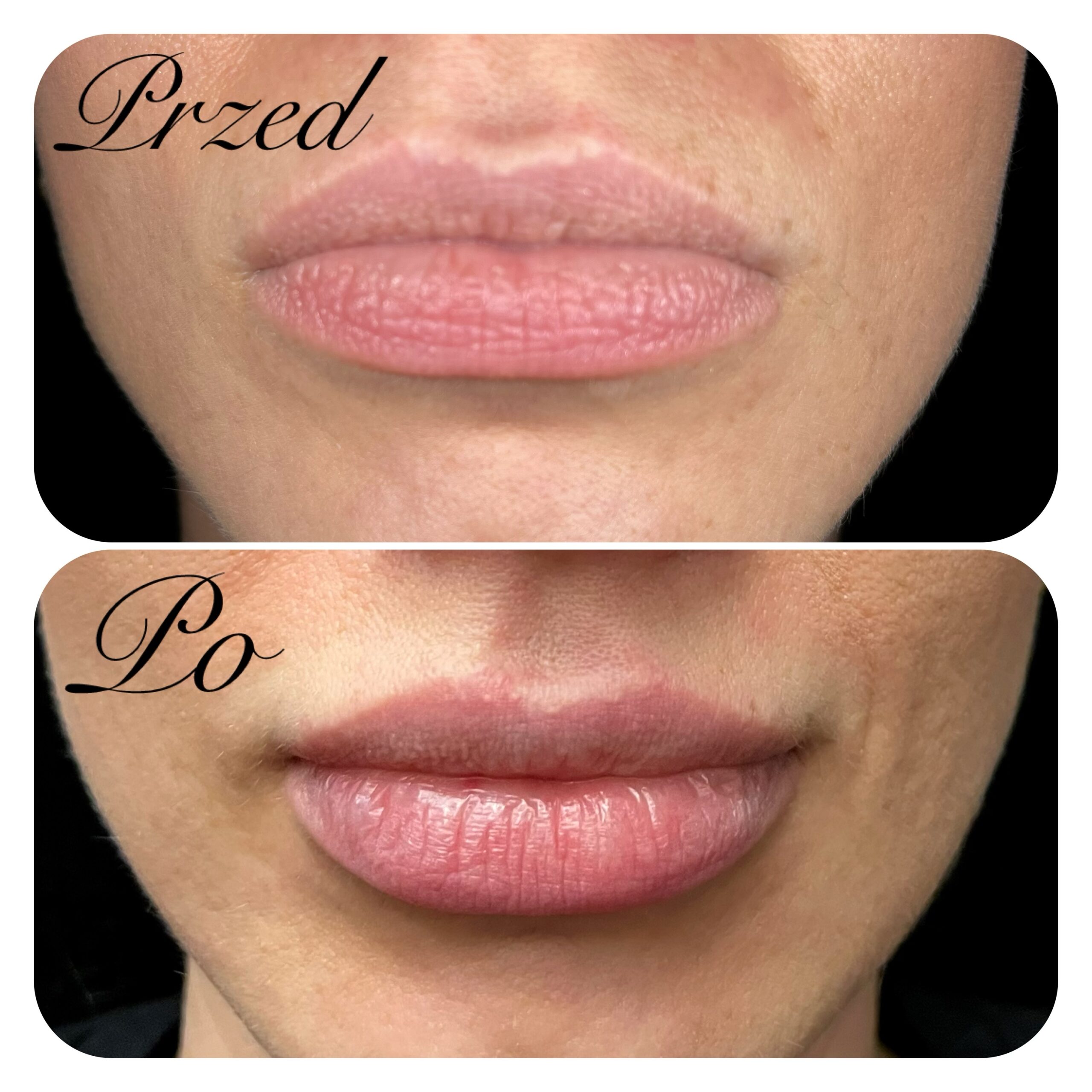 zabieg wykonała dr Agnieszka Nasiłowska-Paciorek. Powiększanie ust kwasem hialuronowym.