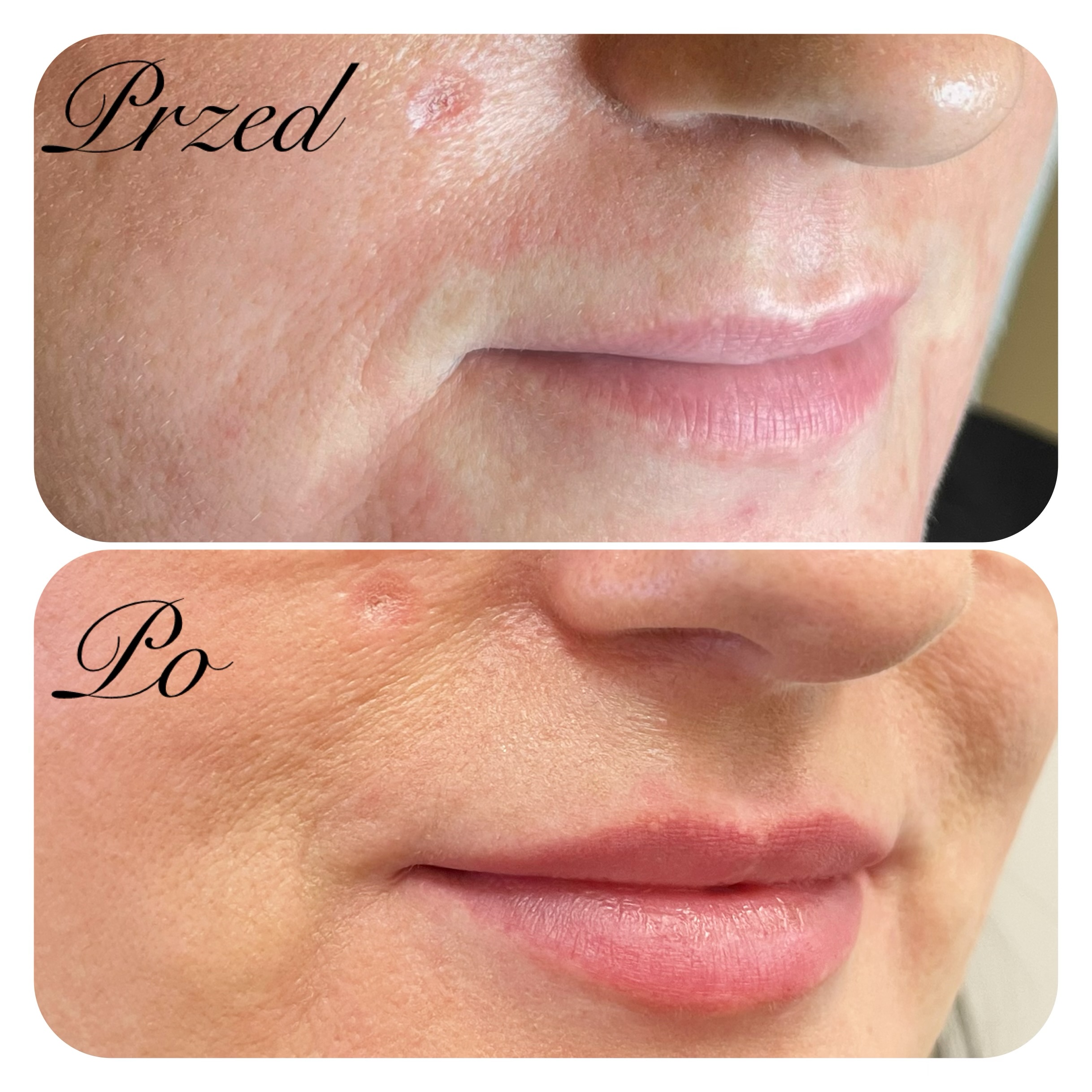 zabieg wykonała dr Agnieszka Nasiłowska-Paciorek. Powiększanie ust kwasem hialuronowym.
