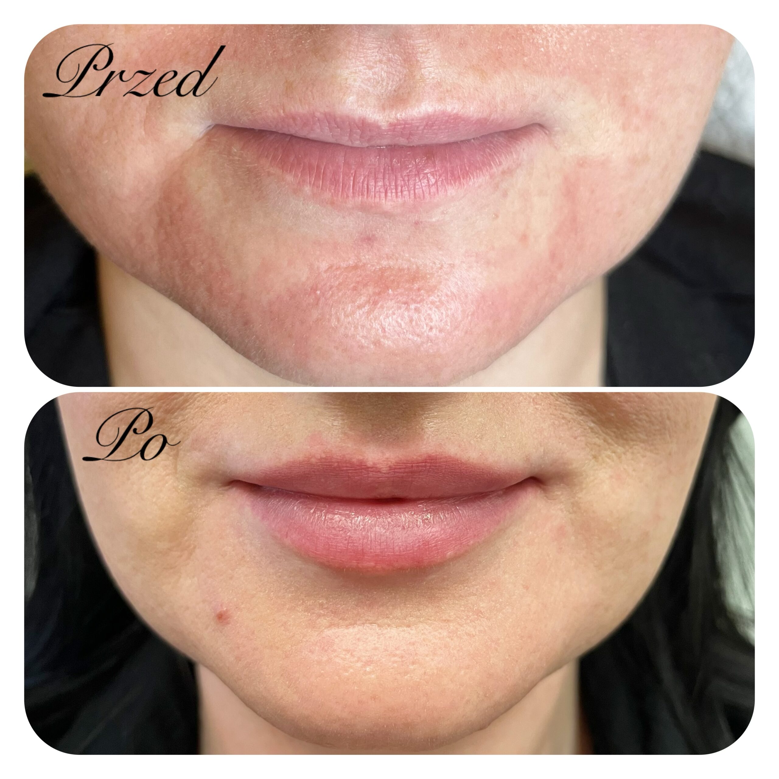 zabieg wykonała dr Agnieszka Nasiłowska-Paciorek. Powiększanie ust kwasem hialuronowym.