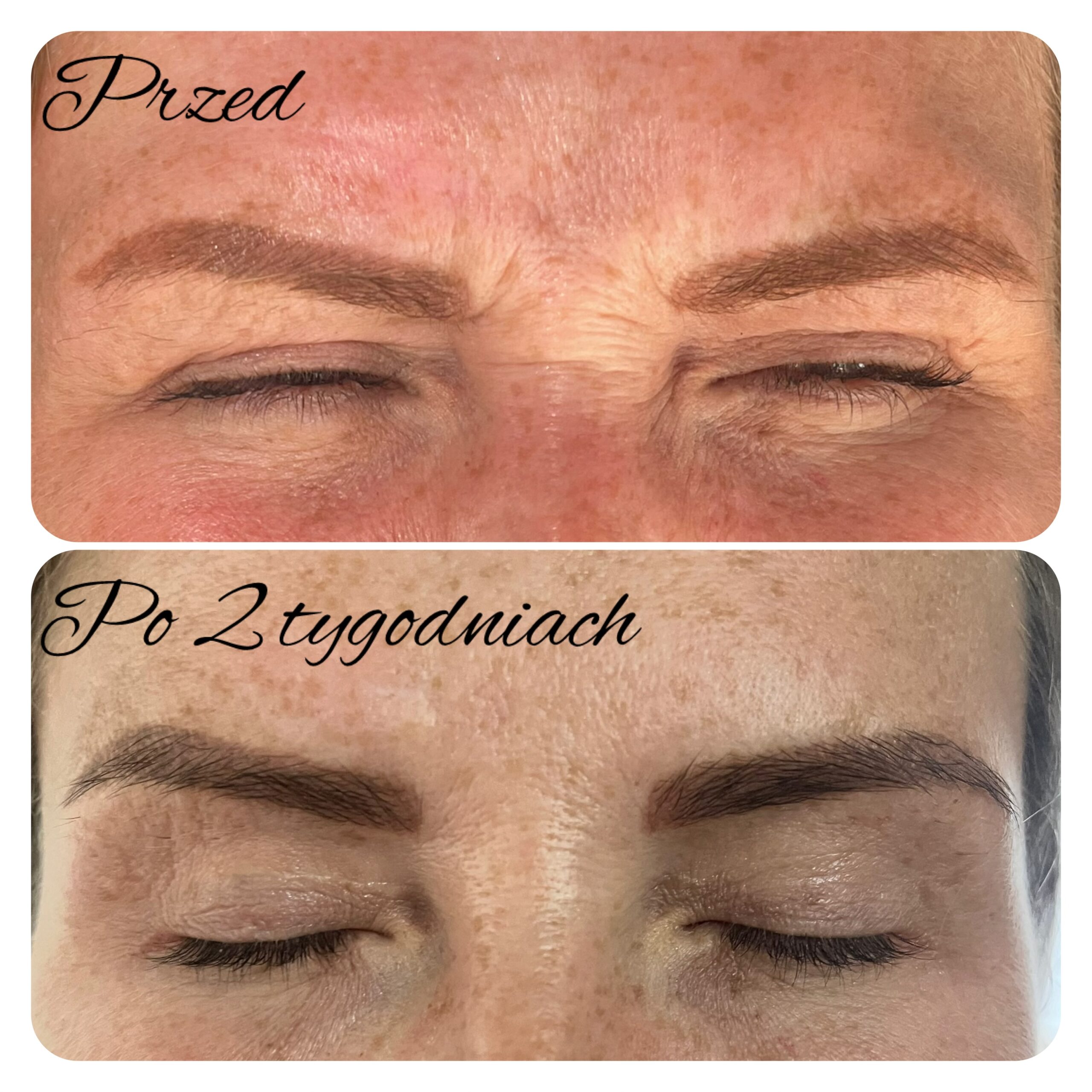 zabieg wykonała dr Agnieszka Nasiłowska-Paciorek. Niwelowanie lwiej zmarszczki przy użyciu toksyny botulinowej