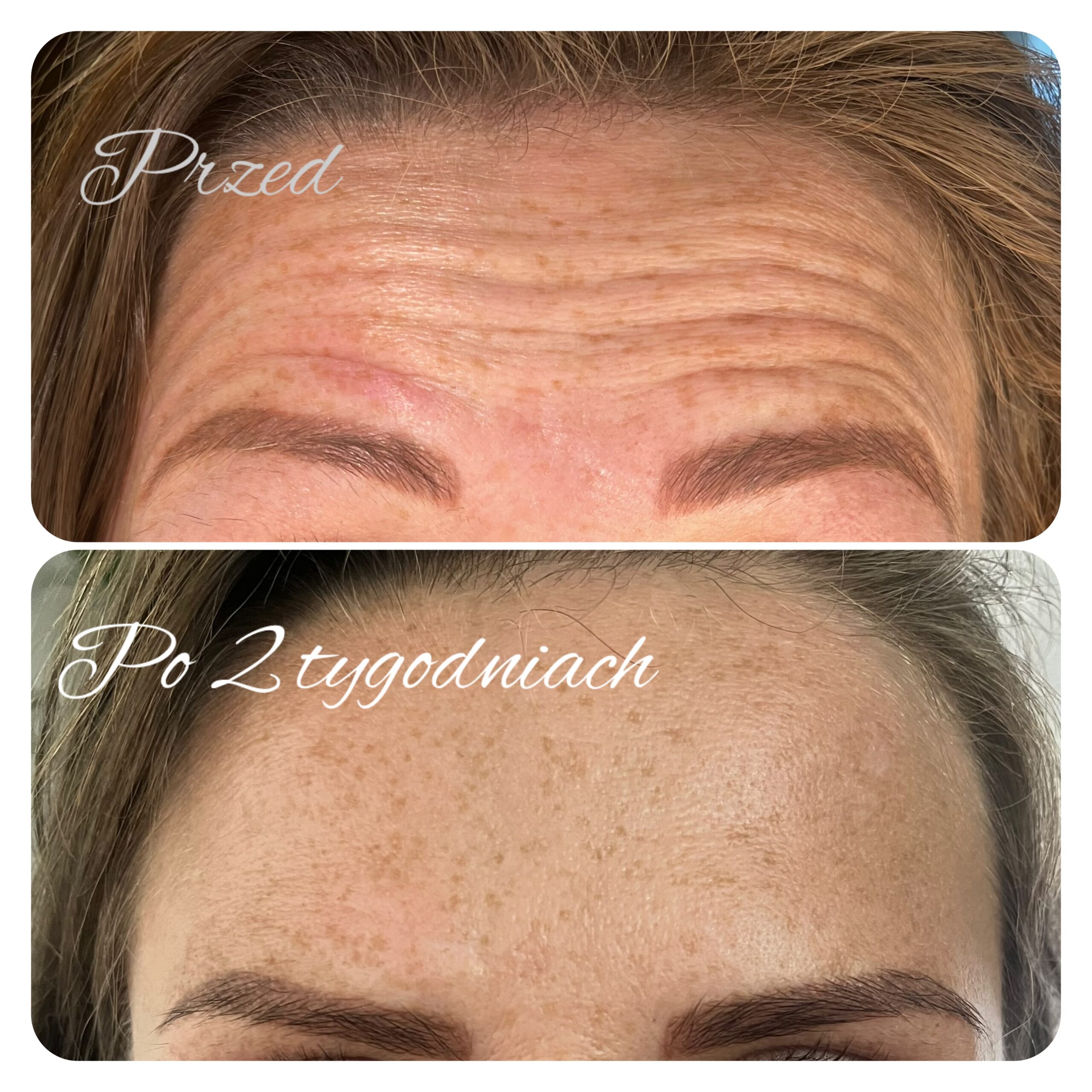 zabieg wykonała dr Agnieszka Nasiłowska-Paciorek. Niwelowanie zmarszczek poprzecznych czoła przy użyciu toksyny botulinowej