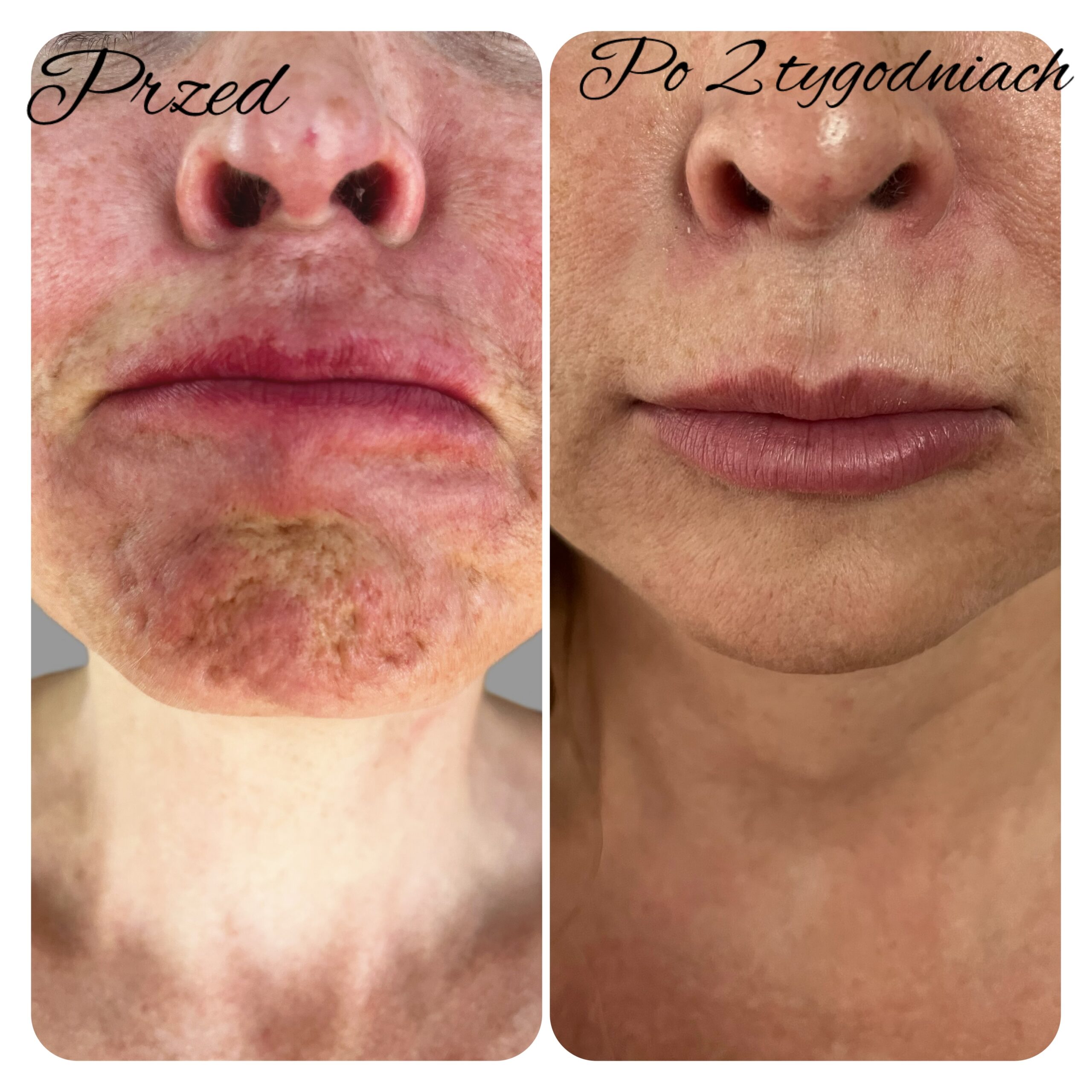 zabieg wykonała dr Agnieszka Nasiłowska-Paciorek. leczenie brody brukowanej i obniżacza kąta ust przy użyciu toksyny botulinowej