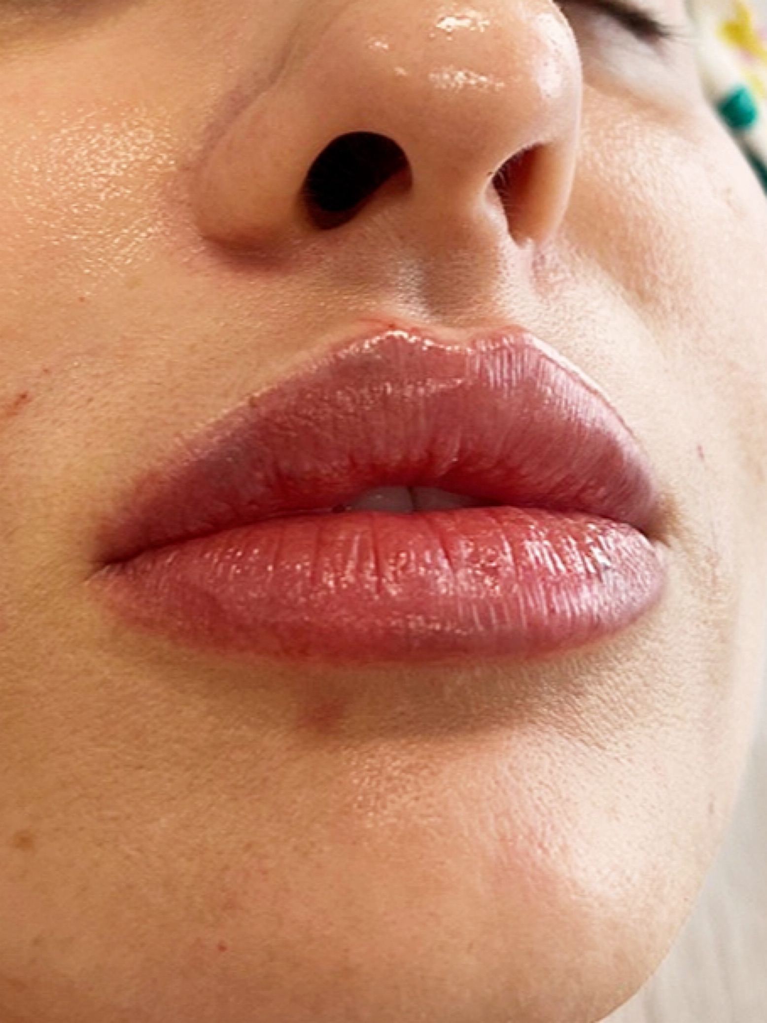 zabieg wykonała dr Agnieszka Nasiłowska-Paciorek. Powiększanie ust kwasem hialuronowym.